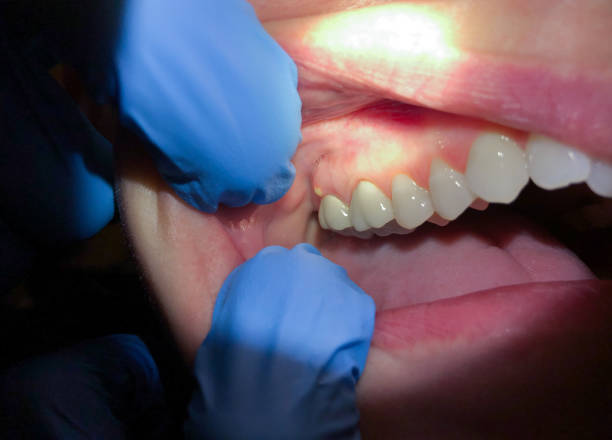 Best Emergency Dental Care for Abscessed Tooth in Thompson Falls, MT